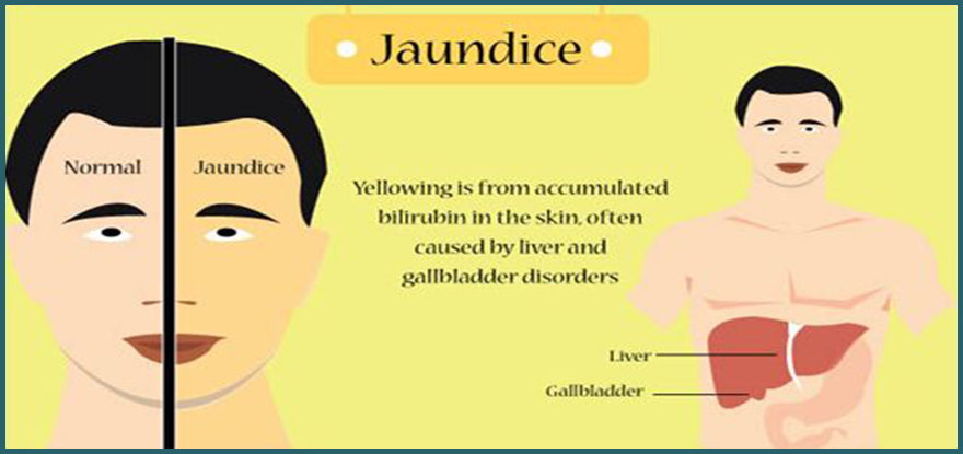 jaundice